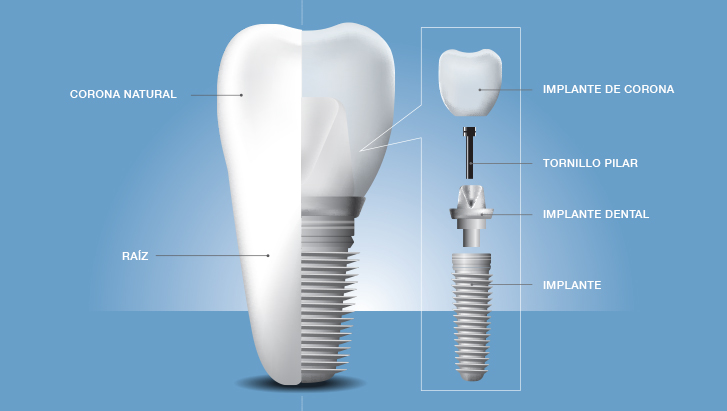 implante-dental-marbella.jpg
